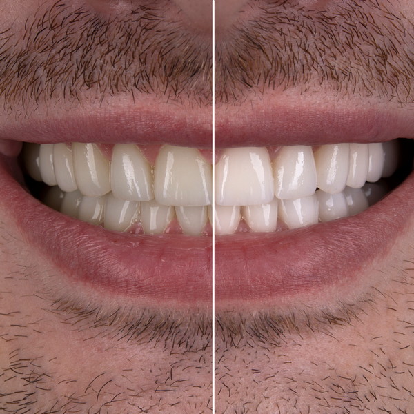 tim dent milicic izbjeljivanje zubi